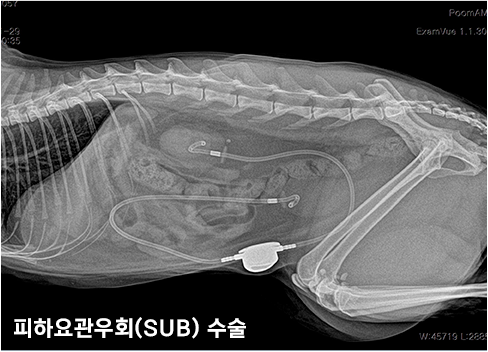 SUB 수술