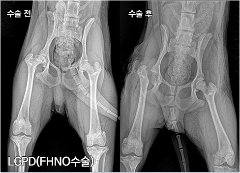 LCPD-FHNO수술